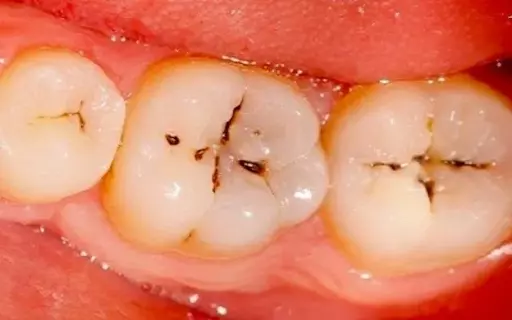 Tổng quan chi tiết về sâu răng: Những thông tin cần thiết.